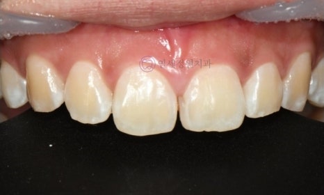 앞니 심미 레진 치료 : 블랙트라이앵글, 앞니 사이 공간 @ 대치동 연세정원치과 관련 이미지 5