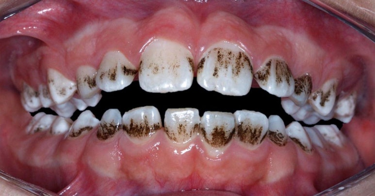 유치가 까맣게 착색이 되었는데 충치인가요? (대치동 소아치과) 관련 이미지 2