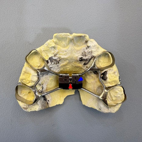 악궁확장장치(RPE, MARPE, MSE) 돌리는 방법 관련 이미지 8