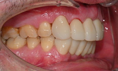 과개교합과 손상된 앞니, 심미와 기능을 함께 회복한 앞니 심미보철 케이스 관련 이미지 9