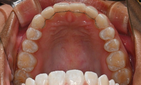 인비절라인 앞니 사이 공간 및 덧니 교정 관련 이미지 15