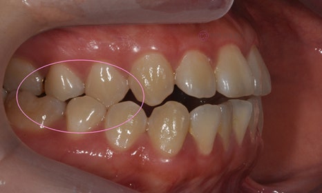 치아 중심선 비대칭 및 개방교합 교정, 대치동 연세정원치과 관련 이미지 2