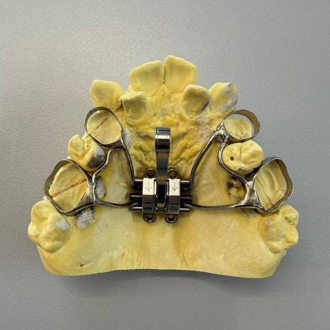 악궁확장장치(RPE, MARPE, MSE) 돌리는 방법 관련 이미지 14