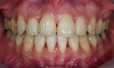 Dental Bonding for Gaps Between Front Teeth & Black Triangles | Gangnam, Seoul 관련 이미지 7