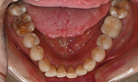 대치동 치경부 레진 & 중년교정 & 치아미백으로 자연스러운 미소를! 관련 이미지 6