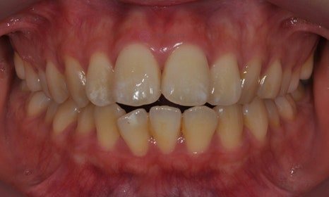 앞니가 안 물려요! 개방교합(openbite) 치아교정 전후 및 후기 관련 이미지 7