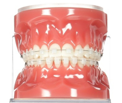 3M 클라리티 울트라 (자가결찰장치) 치아교정 관련 이미지 8