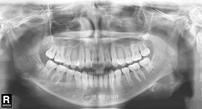 유학생 치아교정, 인비절라인 연세정원치과 관련 이미지 8
