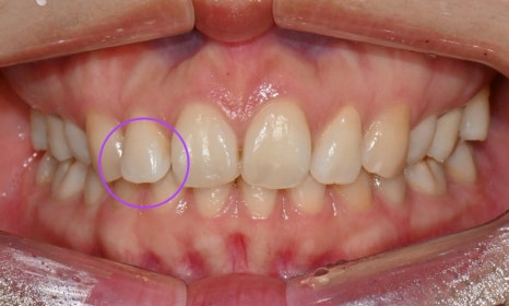 인비절라인 익스프레스 부분교정 <앞니 재교정> 관련 이미지 5