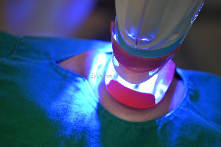 One Day Teeth Whitening Process @ Yonsei JW Dental Clinic 관련 이미지 14