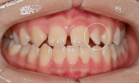 왜소치 치료 - 라미네이트 vs 레진비니어 vs 치아교정 관련 이미지 3