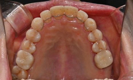 대치동 치경부 레진 & 중년교정 & 치아미백으로 자연스러운 미소를! 관련 이미지 17