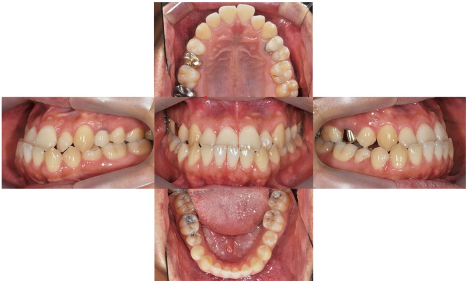 주걱턱 치아 교정만으로 치료 가능할까요? @ 대치동 교정치과 연세정원치과 관련 이미지 2