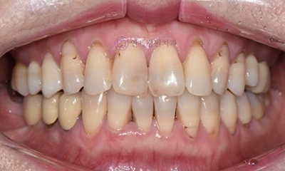 Front Tooth Resin Treatment in Korea: Microdontia, Gaps & Black Triangles 관련 이미지 10