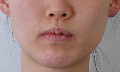 앞니가 안 물려요! 개방교합(openbite) 치아교정 전후 및 후기 관련 이미지 10