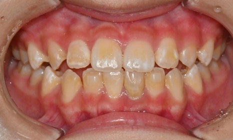 교정 치료 후 치아 미백 관련 이미지 5