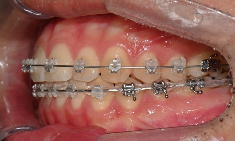 치아 중심선 비대칭과 아랫입술 돌출 개선 관련 이미지 15