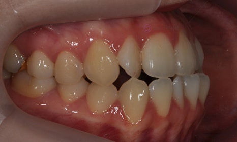 치아 중심선이 안 맞아요! 치아 비대칭 교정으로 가능할까요? @ 대치동 교정치과 연세정원치과 관련 이미지 6