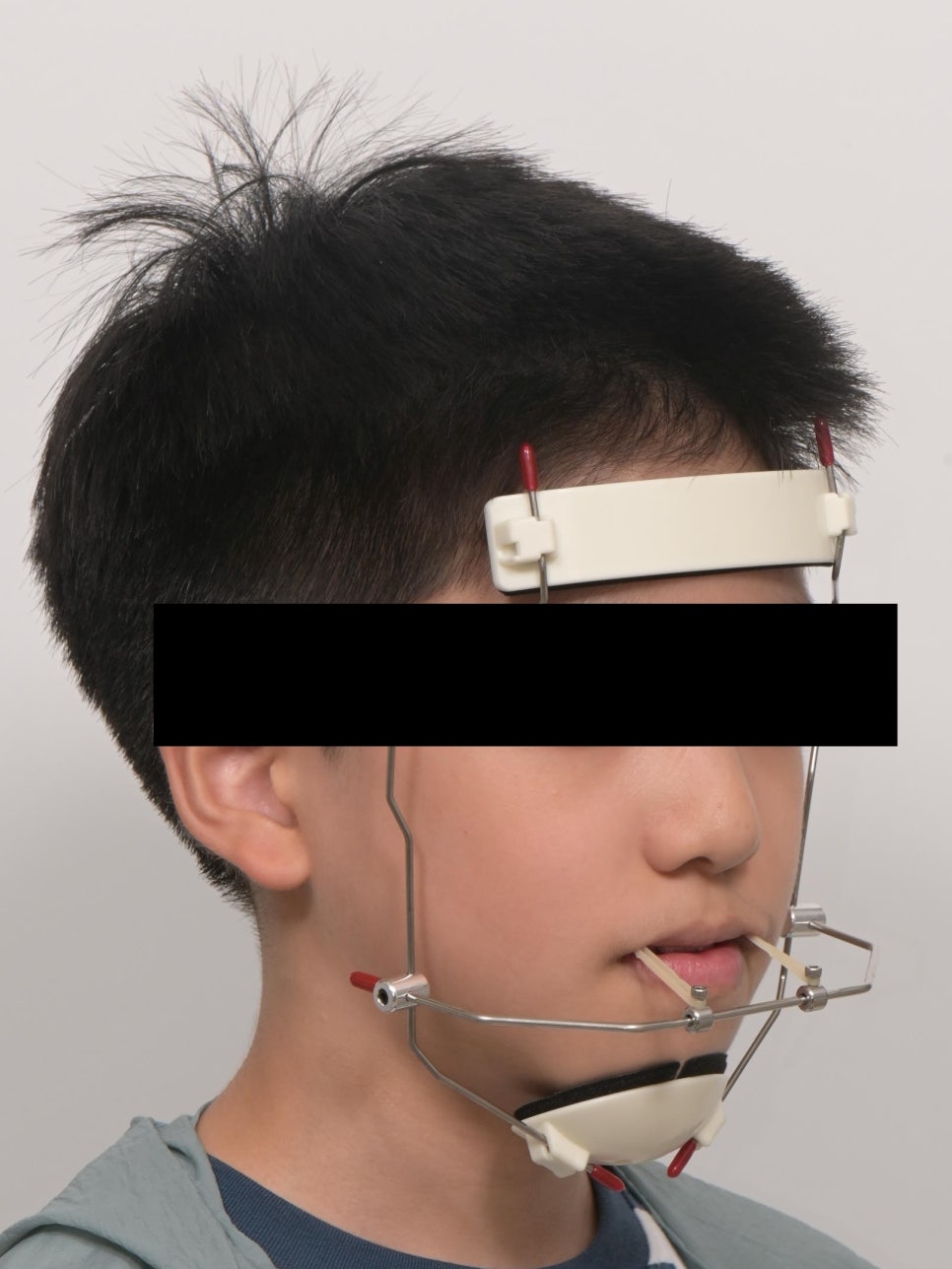 어린이 주걱턱, 페이스 마스크 성장교정 후 인비절라인 관련 이미지 2