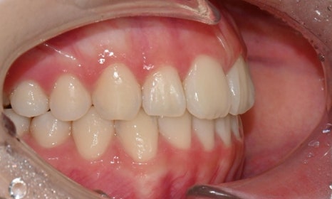 고등학생 인비절라인 교정｜앞니 치아배열 &middot; 과개교합 관련 이미지 18