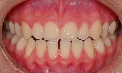 어린이 주걱턱, 페이스 마스크 성장교정 후 인비절라인 관련 이미지 11