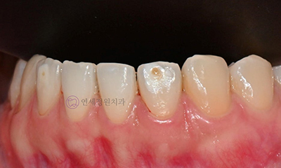 ICON Resin Treatment: White Spots on Front Teeth - Are They Cavities? 관련 이미지 9