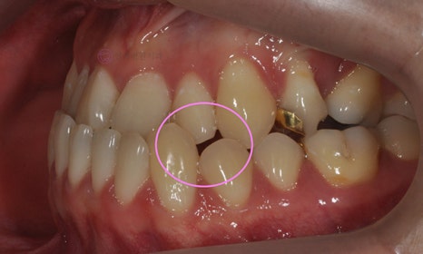 비대칭 및 돌출입 치아교정, 대치동 교정치과 연세정원치과 관련 이미지 3