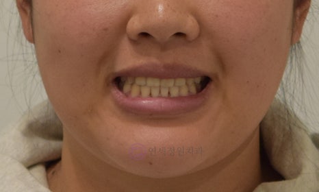 치아 중심선 비대칭 및 개방교합 교정, 대치동 연세정원치과 관련 이미지 11