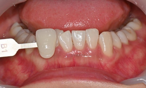 원데이 치아미백의 순서 @ 대치동 치아미백 연세정원치과의원 관련 이미지 17