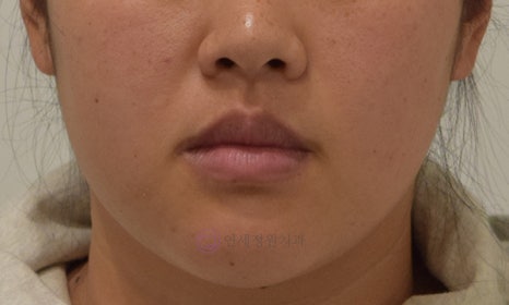 치아 중심선 비대칭 및 개방교합 교정, 대치동 연세정원치과 관련 이미지 10