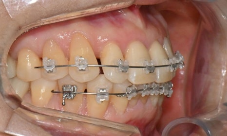 대치동 치경부 레진 & 중년교정 & 치아미백으로 자연스러운 미소를! 관련 이미지 12