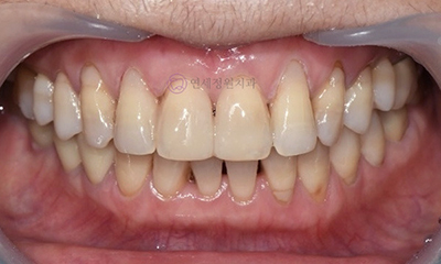 Front Tooth Resin Treatment in Korea: Microdontia, Gaps & Black Triangles 관련 이미지 11