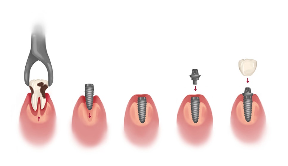 대치동 연세정원치과, 치과 임플란트 종류 및 비용 안내 관련 이미지 2