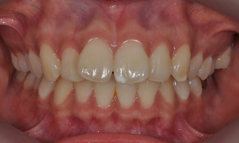 ICON Resin Treatment: White Spots on Front Teeth - Are They Cavities? 관련 이미지 2