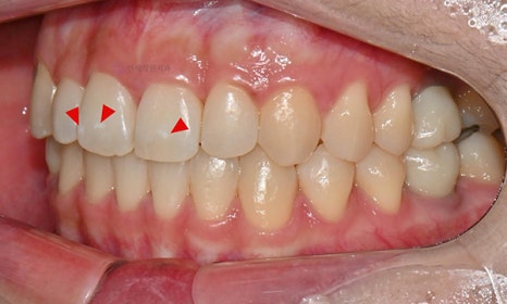 교정치료 후 생긴 치아 하얀 점, 반점치도 아이콘 치료로! @ 대치동 교정치과 연세정원치과의원 관련 이미지 5