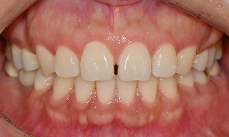 앞니 벌어짐 부분교정 (재교정) 관련 이미지 3
