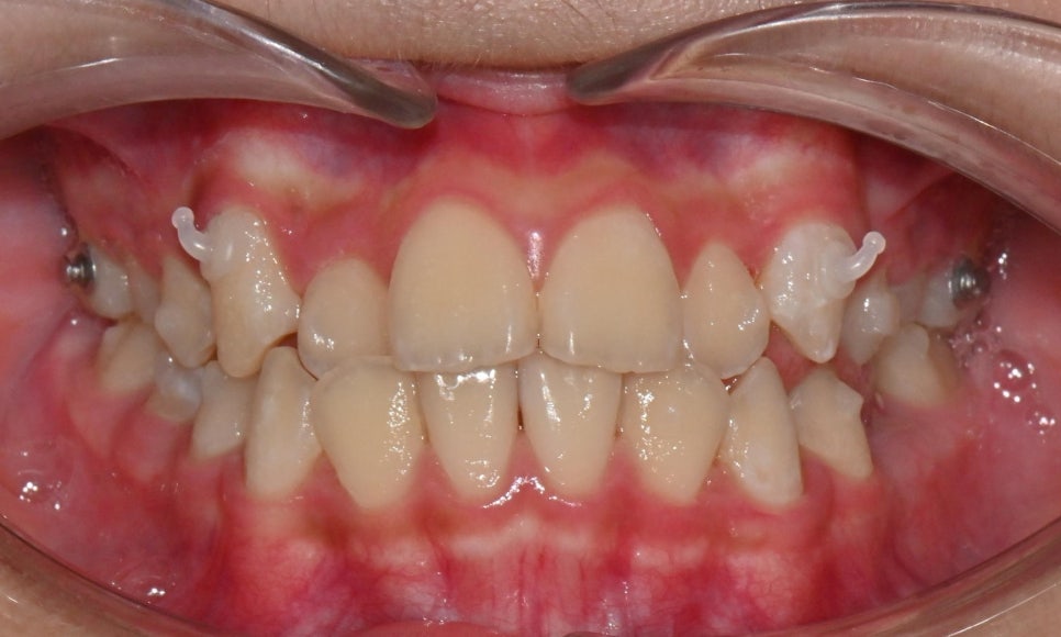 어린이 주걱턱 교정 - 페이스 마스크와 인비절라인 퍼스트 관련 이미지 6
