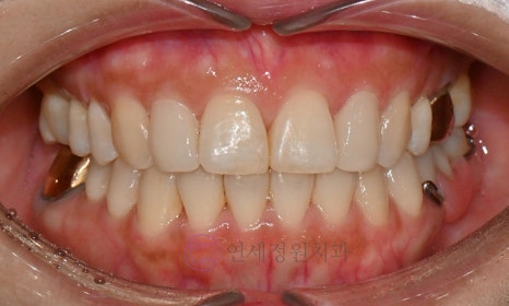 왜소치 치료 - 라미네이트 vs 레진비니어 vs 치아교정 관련 이미지 20