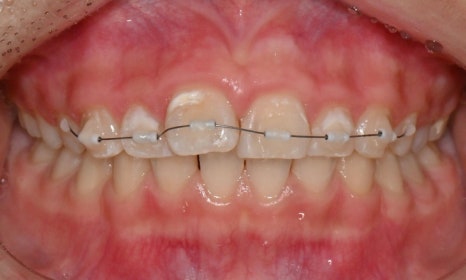 인비절라인 익스프레스 부분교정 <앞니 재교정> 관련 이미지 3