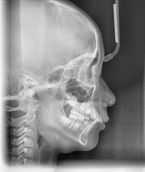 어린이 무턱 액티베이터 성장교정 후 인비절라인 퍼스트 관련 이미지 4