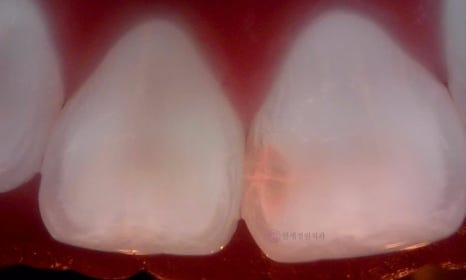 앞니 심미 레진 치료 : 블랙트라이앵글, 앞니 사이 공간 @ 대치동 연세정원치과 관련 이미지 13