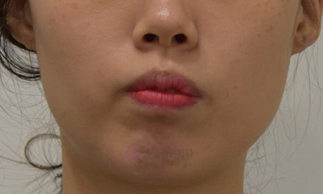 앞니가 안 물려요! 개방교합(openbite) 치아교정 전후 및 후기 관련 이미지 5