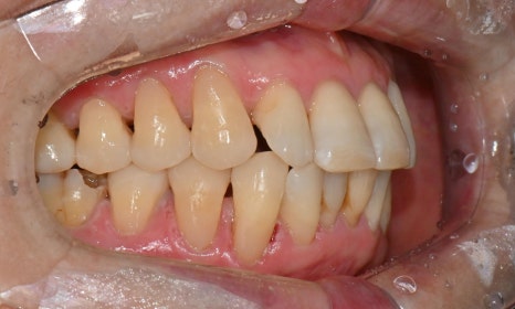 대치동 치경부 레진 & 중년교정 & 치아미백으로 자연스러운 미소를! 관련 이미지 10