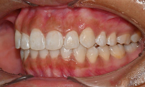 개포동 앞니 사이 공간 및 덧니 교정을 원한다면 관련 이미지 14