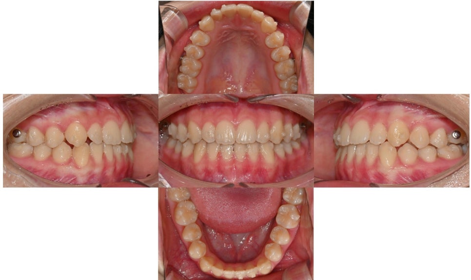 어린이 주걱턱, 페이스 마스크 성장교정 후 인비절라인 관련 이미지 8