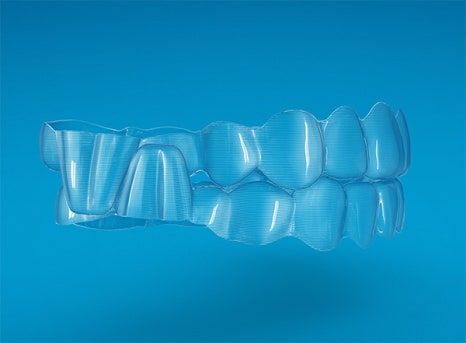 인비절라인의 장점 @ 대치동교정치과 연세정원치과의원 관련 이미지 2