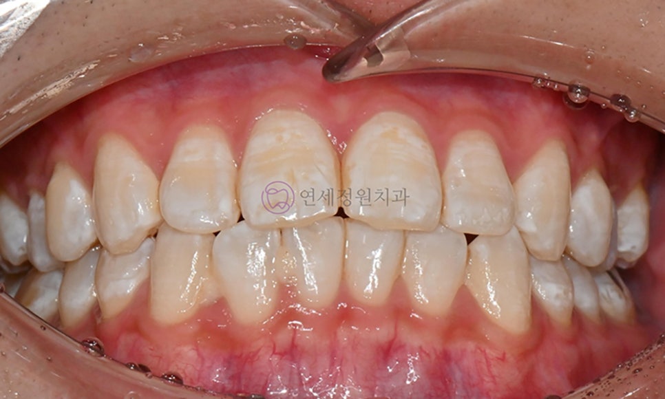 치아 미백 후 반점치의 아이콘 레진 치료 @ 대치동 연세정원치과 관련 이미지 2
