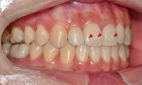 교정치료 후 생긴 치아 하얀 점, 반점치도 아이콘 치료로! @ 대치동 교정치과 연세정원치과의원 관련 이미지 4