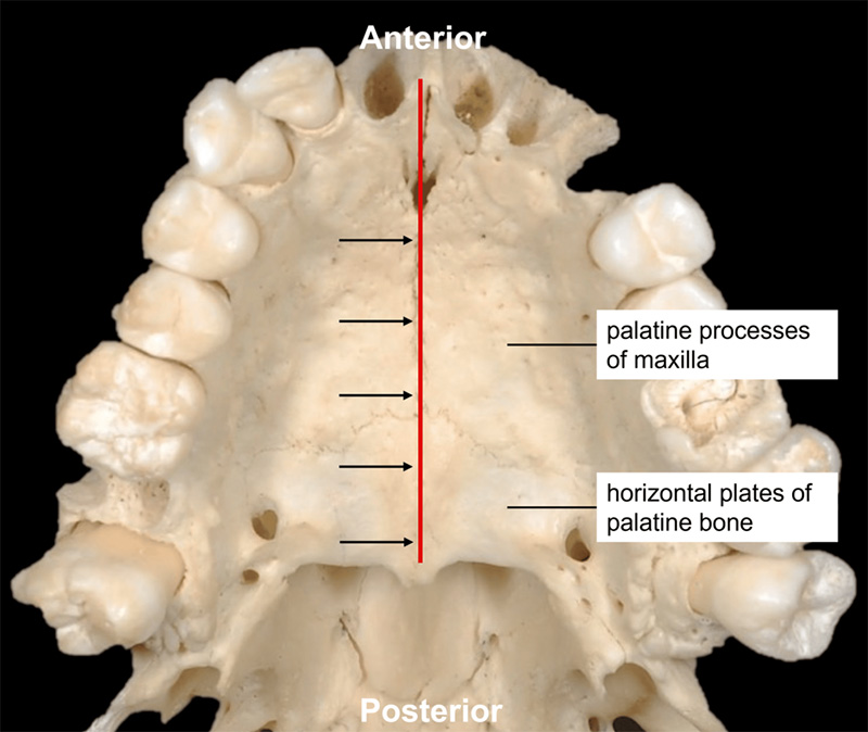 악궁확장장치(RPE, MARPE, MSE) 돌리는 방법 관련 이미지 4