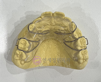 소아교정의 중요성 : 적절한 시기에 유치를 빼주는 것이 중요한 이유 @ 대치동 교정치과 연세정원치과 관련 이미지 6